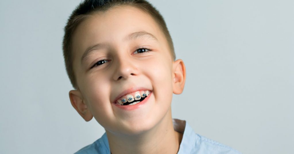 Lứa tuổi thích hợp để niềng răng cho trẻ.