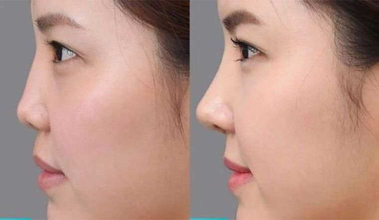 cải thiện đường nét trên khuôn mặt