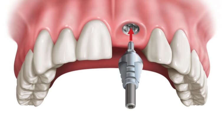 cấy implant