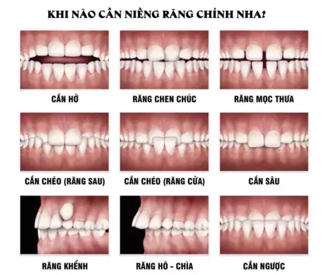 chỉnh nha là gì