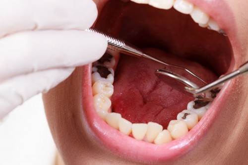 điều trị sâu răng