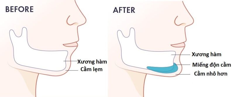 độn cằm