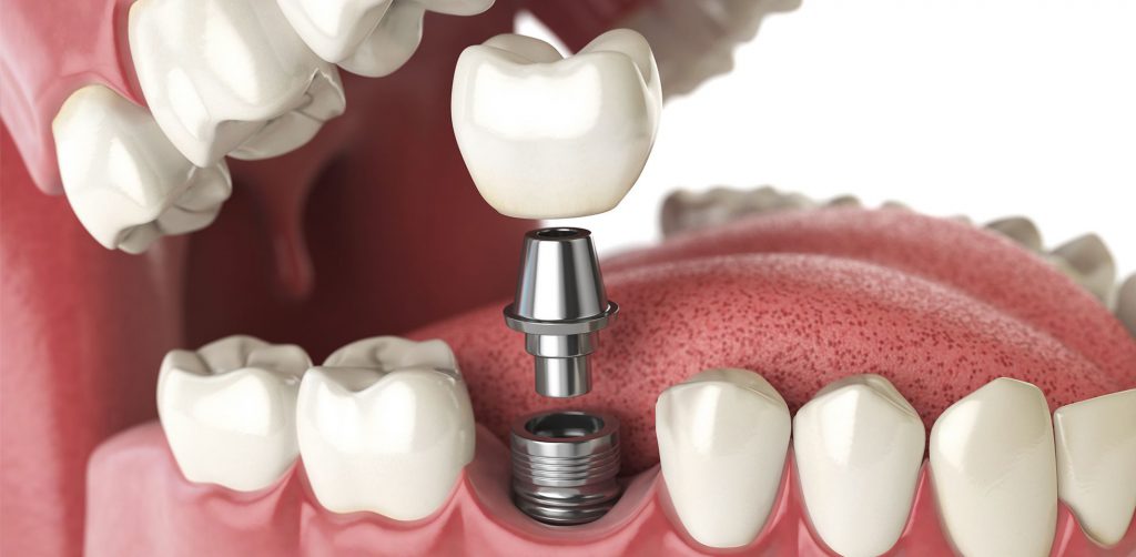 trồng răng implant