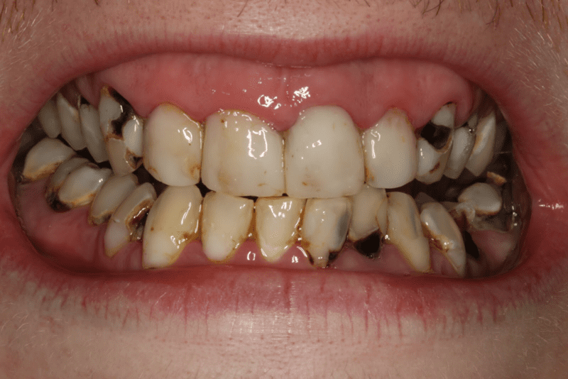 răng sâu