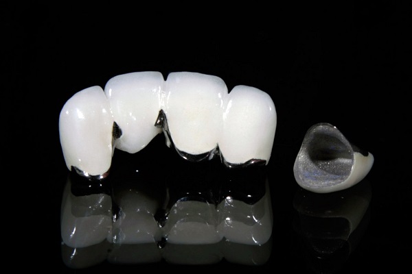 Răng sứ kim loại