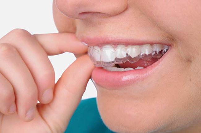 Niềng răng trong suốt invisalign và những điều cần biết | Vinmec