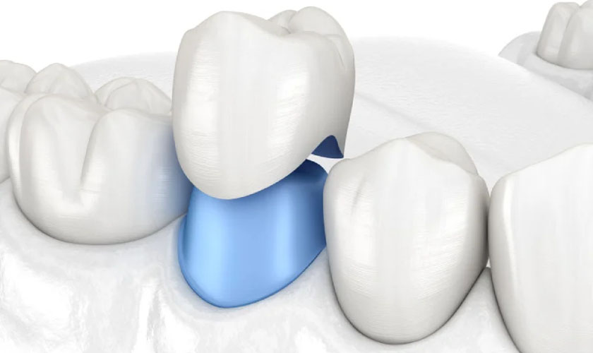 Quá trình bọc răng sứ mất bao lâu để hoàn thành?