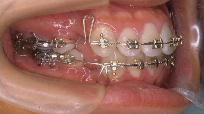 Dây cung niềng răng là gì? Vai trò của dây cung trong chỉnh nha
