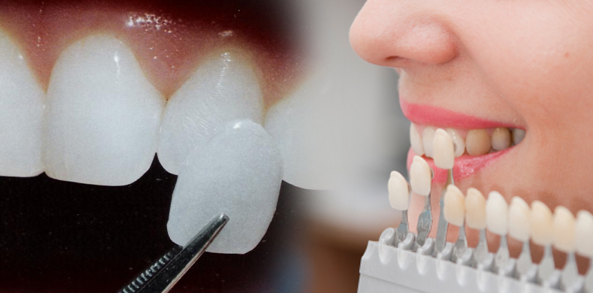 Mặt dán sứ veneer - Phục hình răng đẹp, bảo tồn răng thật tối đa
