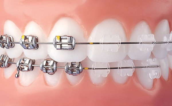 Niềng răng mắc cái sứ là gì? Tất tần tật thông tin bạn cần biết