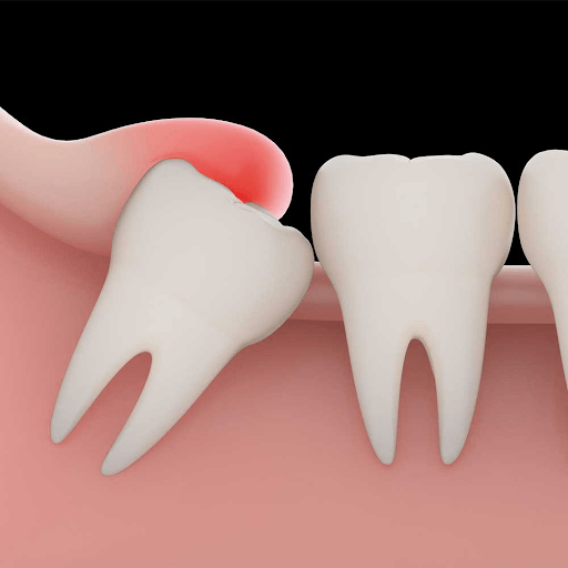 Đau răng khôn, mọc răng cùng- Triệu chứng và cách chữa trị