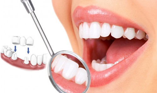 Bọc răng thẩm mỹ: Những mối nguy cần lưu ý