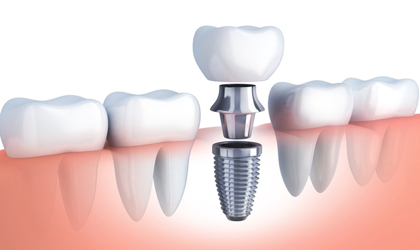 Cấy ghép răng Implant có đau không? Có biến chứng không?