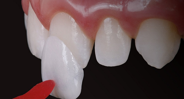 Mặt dán sứ veneer và Bọc răng sứ: Những điều cần biết