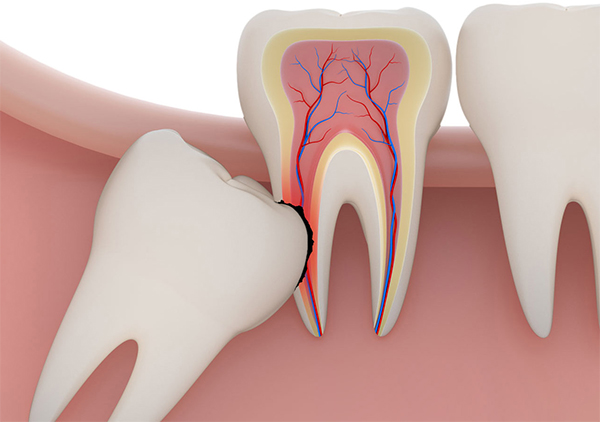 Bảng giá nhổ răng khôn không đau tại Nha Khoa LINH XUÂN