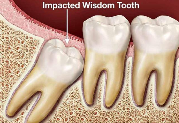 Răng khôn là răng nào? Một người có bao nhiêu răng khôn? | Vinmec