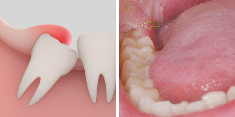 Răng khôn là gì? Hình ảnh răng khôn mọc đúng, lệch & Có nên nhổ? | Colgate®