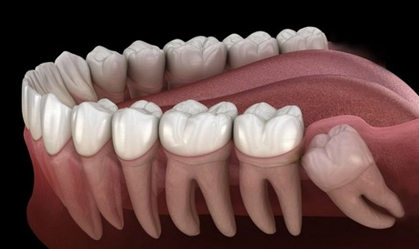 Răng khôn là răng số mấy? Có nên nhổ răng khôn không?