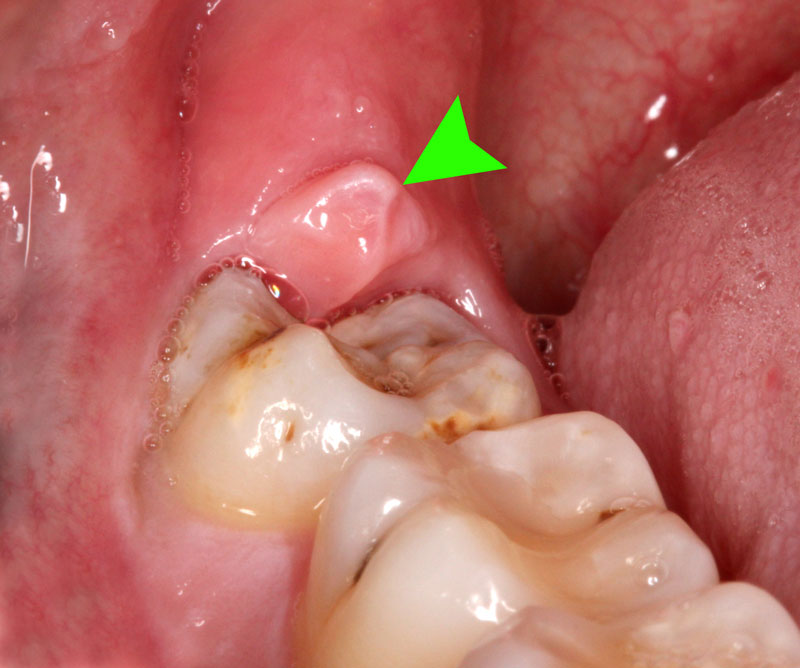 Răng khôn là gì và những trường hợp cần nhổ bỏ răng khôn?