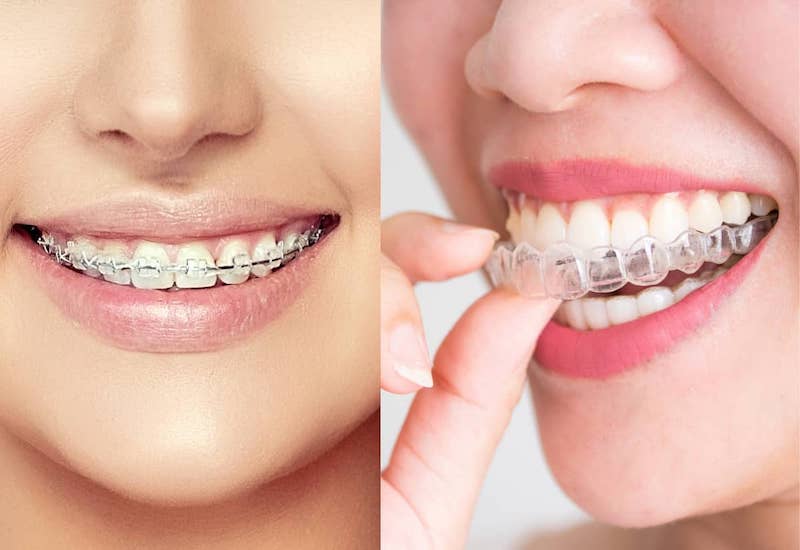 Niềng răng invisalign là gì? Có hiệu quả hơn niềng răng thông thường không?