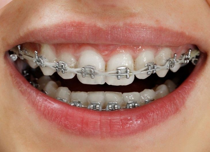 Quy trình niềng răng mắc cài kim loại - Nha Khoa Quốc Tế Times Dental 105  Đào Tấn