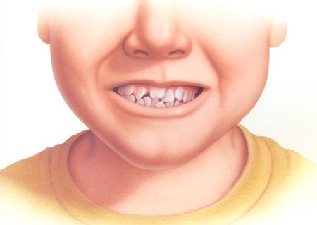Nguyên nhân và ảnh hưởng của răng mọc chen chúc | Vinmec