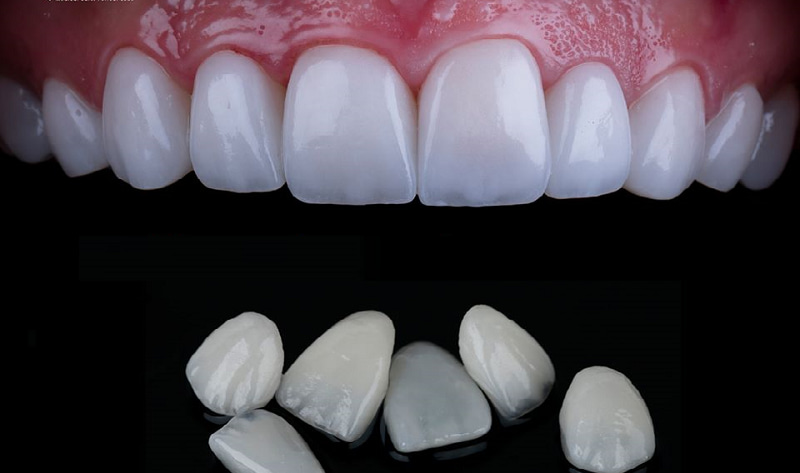 So sánh dán sứ veneer và bọc răng sứ