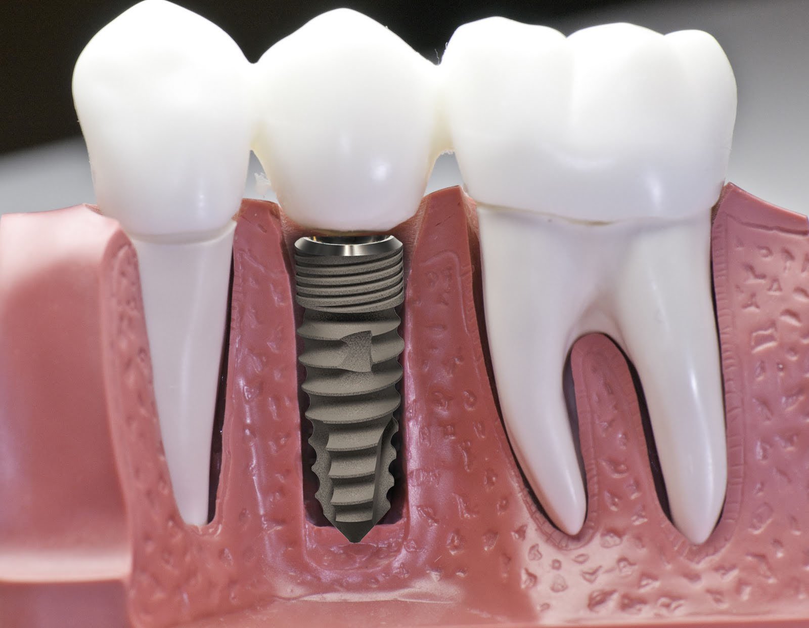 Răng giả làm từ chất liệu gì? | Vinmec
