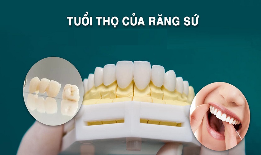 Bọc răng sứ có bền không? Tuổi thọ duy trì được bao lâu?