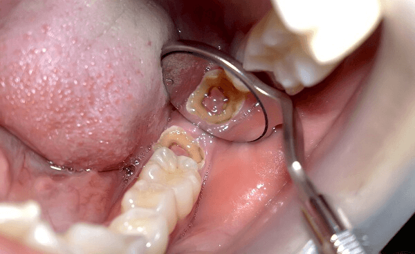 Một quy trình điều trị tủy răng mất bao lâu phụ thuộc nhiều yếu tố