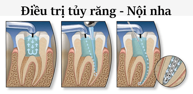 Chi phí điều trị tủy răng